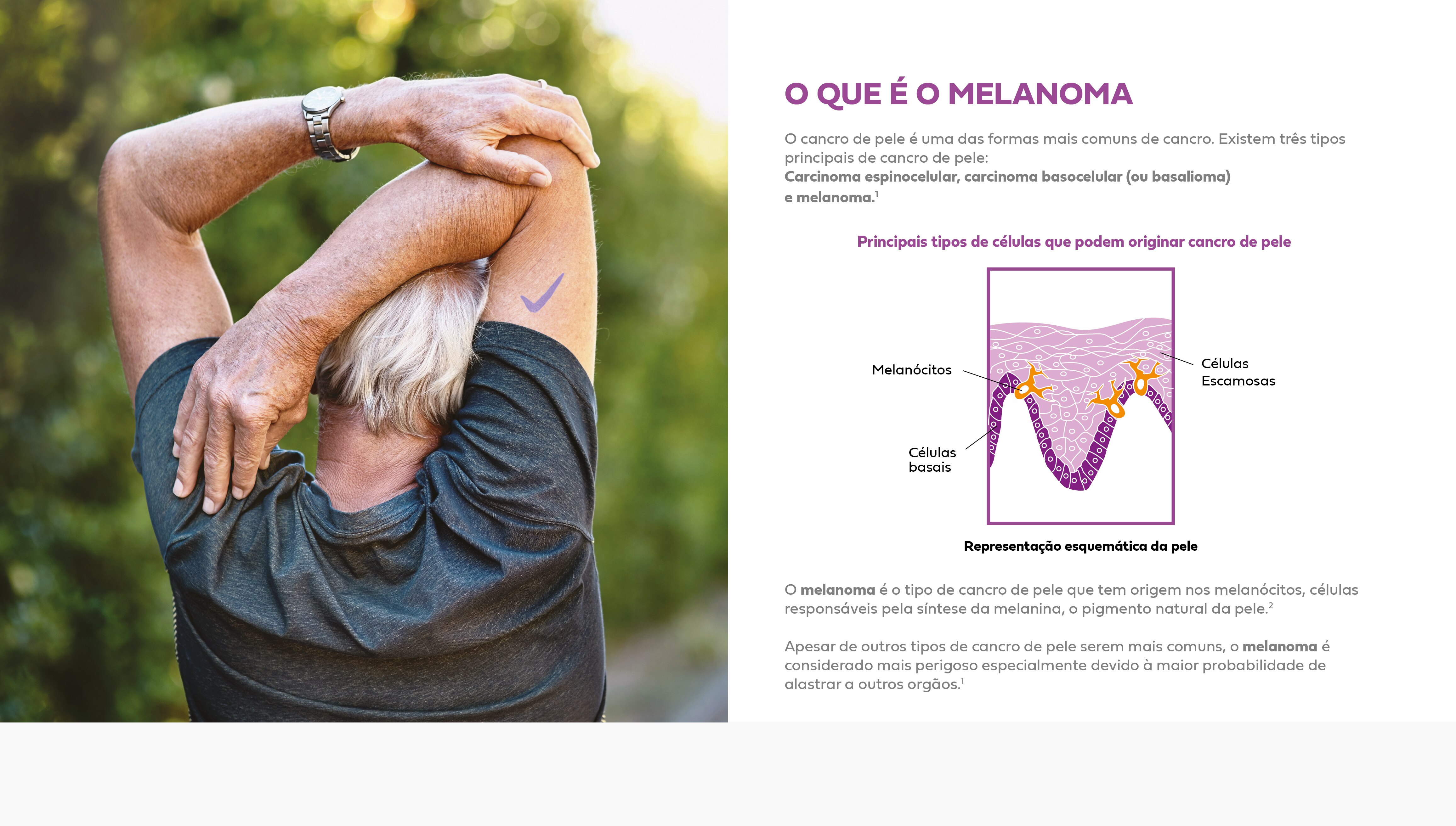 Melanoma