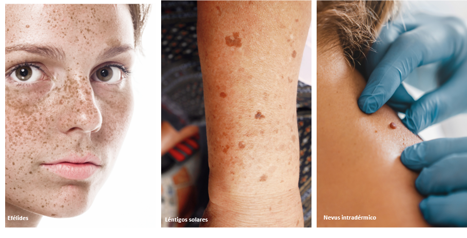 Tríptico Melanoma