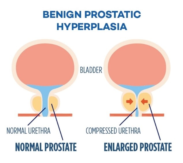 schema benign prostatic hyperplasia