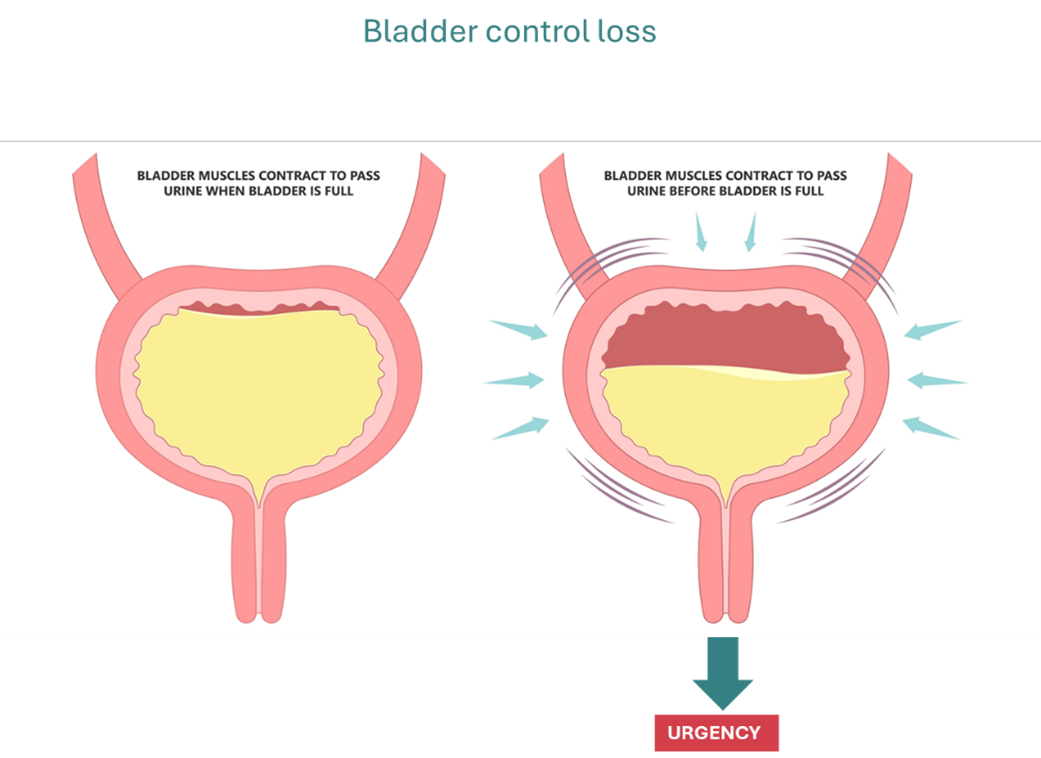 bladder control loss